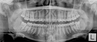 Teeth Removal Ocean Gorve