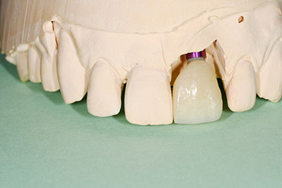 Dental Implants Ocean Gorve